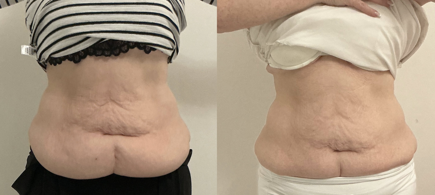 Before and after back contouring — client 2