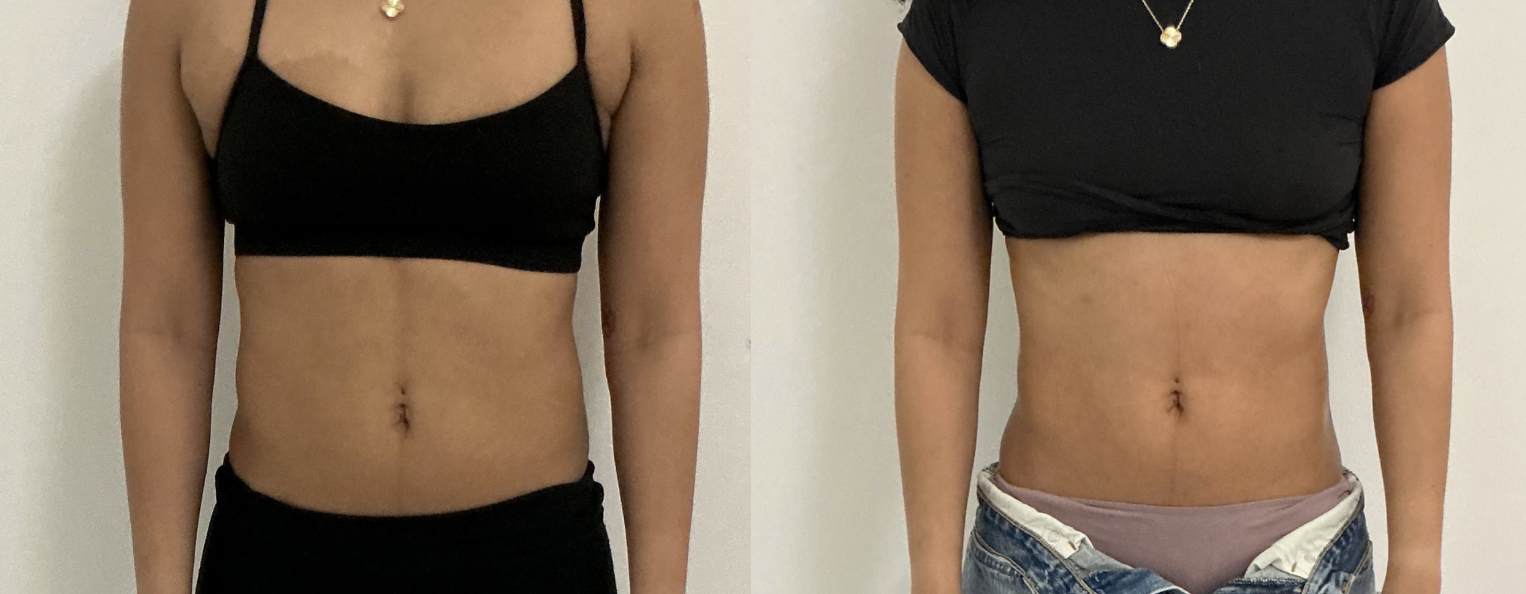 Before and after abdomen contouring — client 1
