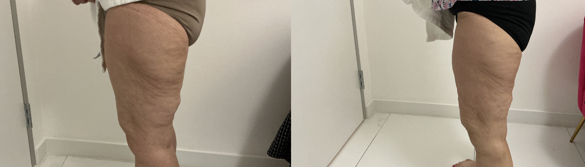 Before and after leg contouring — client 4