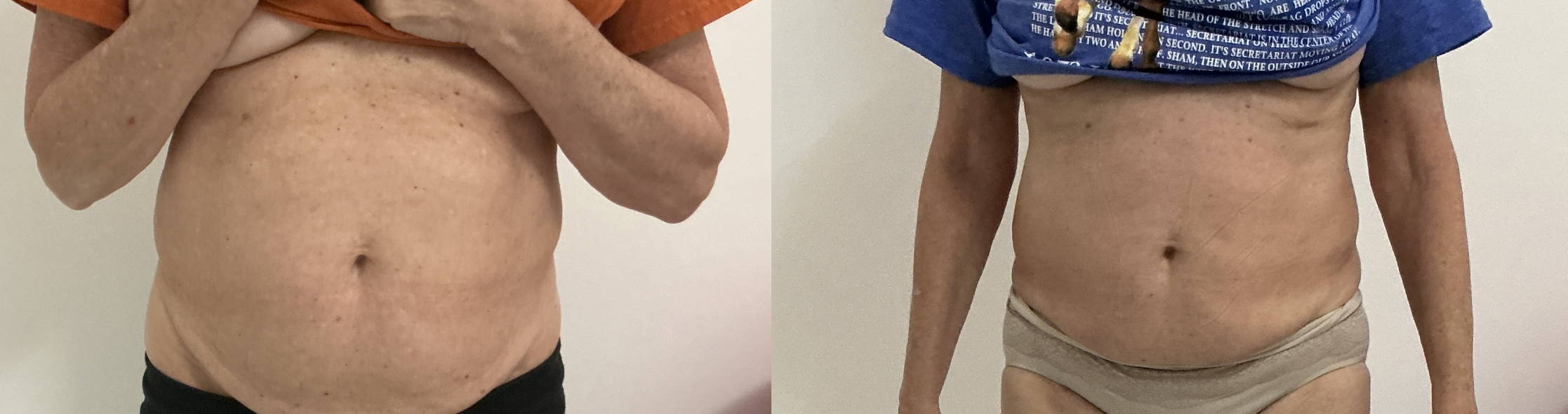 Before and after abdomen contouring — client 3